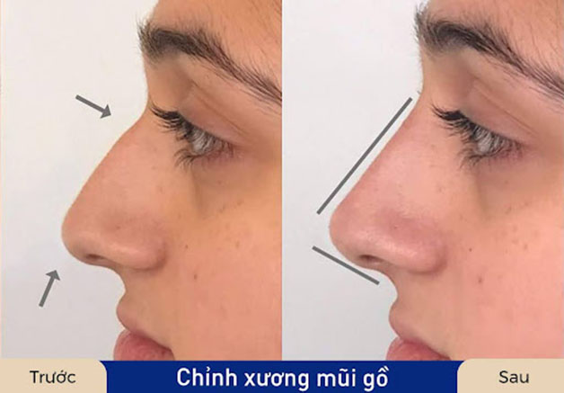 Sửa mũi gồ giúp sống mũi thẳng và đẹp hơn