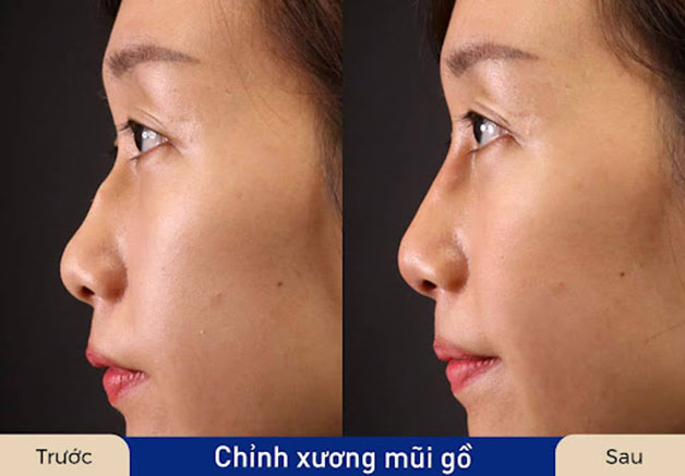 Sửa mũi gồ đơn giản thường có giá thấp hơn trường hợp phức tạp