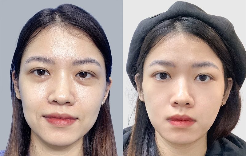 Căng chỉ collagen giúp khắc phục tình trạng da chảy xệ, có nếp nhăn