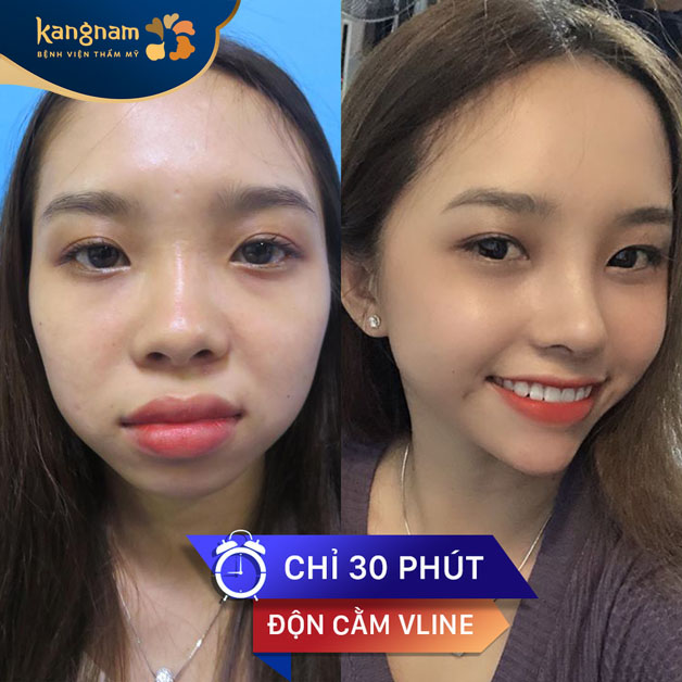 Khách hàng sở hữu dáng cằm V-line thon gọn sau độn cằm tại Kangnam