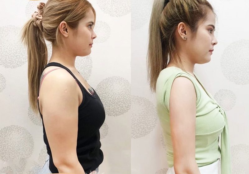 Hút mỡ bắp tay giúp đôi tay thon gọn, săn chắc hơn