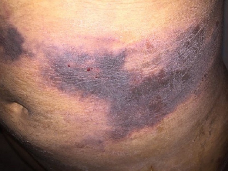 Vùng bụng bị bầm tím, hoại tử