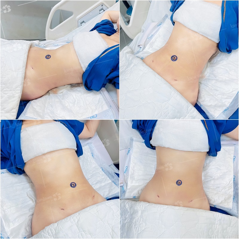 Vùng bụng cần có thời gian hồi phục và ổn định sau hút mỡ