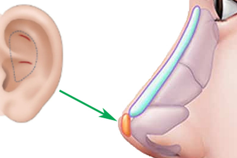 Lấy sụn tai nâng mũi giúp hạn chế bóng đỏ, lộ sống