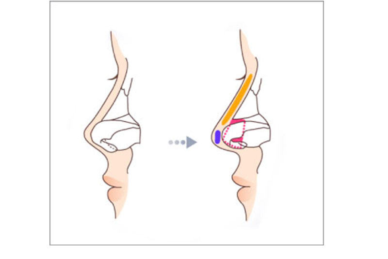 Sửa mũi chỉ can thiệp vào mô mềm, sụn hoặc xương mũi