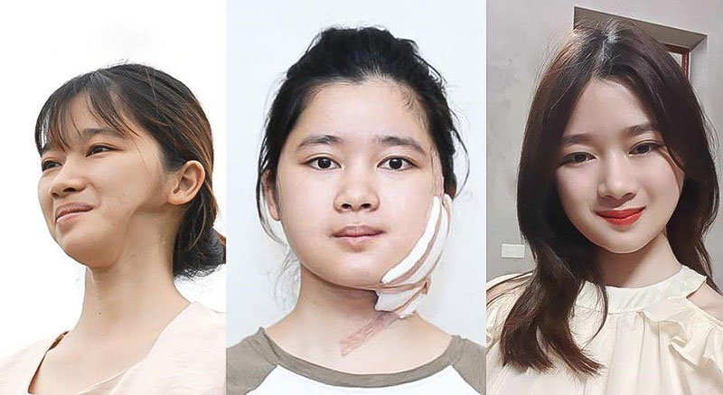 Ninh Thị Thu Hường và quá trình trước, trong, sau khi chỉnh hàm