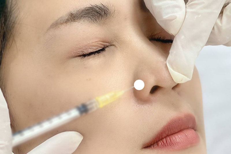 Tiêm botox thu gọn cánh mũi là phương pháp tiêm dung dịch botox vào vùng mô cơ mũi