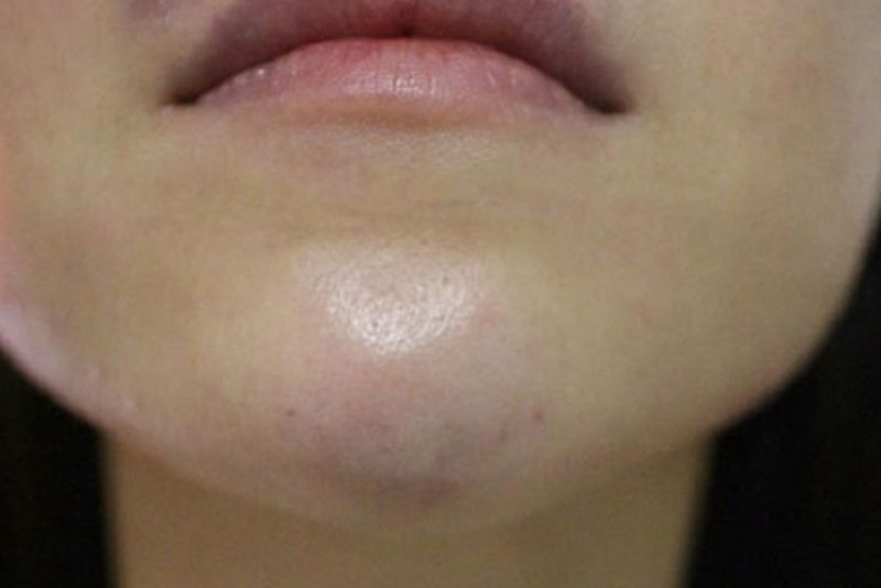 Đau nhức sau tiêm filler cần thăm khám ngay