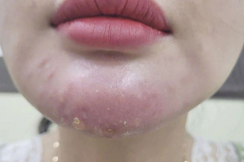 Biến chứng khi tiêm filler sai kỹ thuật