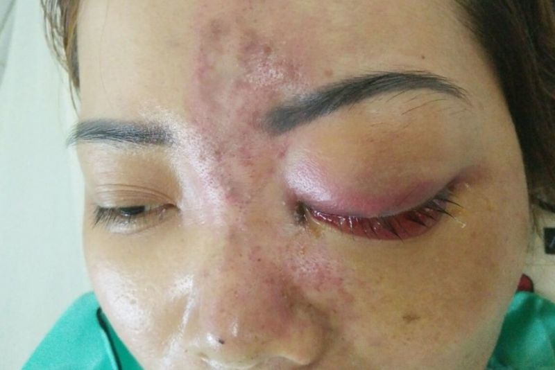 Sản phẩm filler kém chất lượng gây biến chứng nặng nề