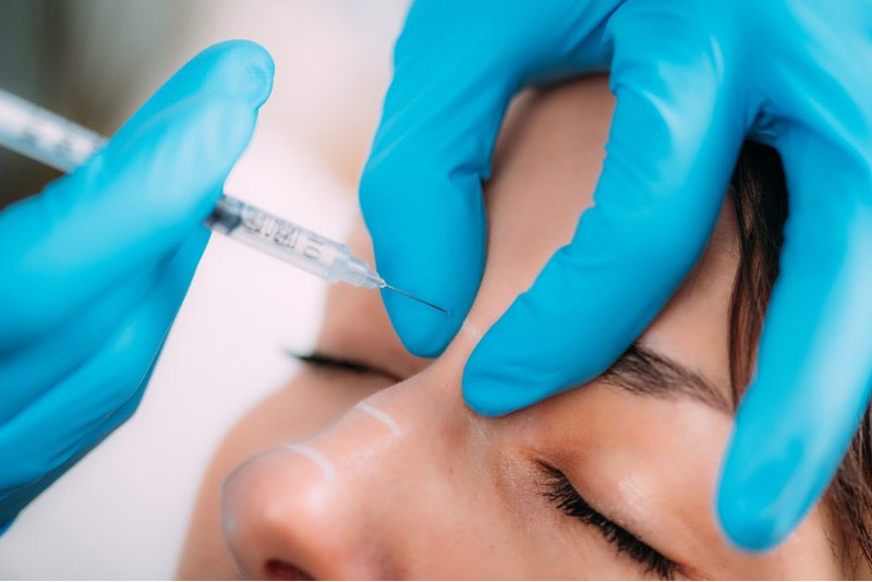 Tiêm filler nâng mũi duy trì 6 tháng đến 2 năm