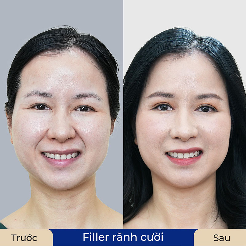 Nếu có rãnh nhăn sâu nên tiêm filler