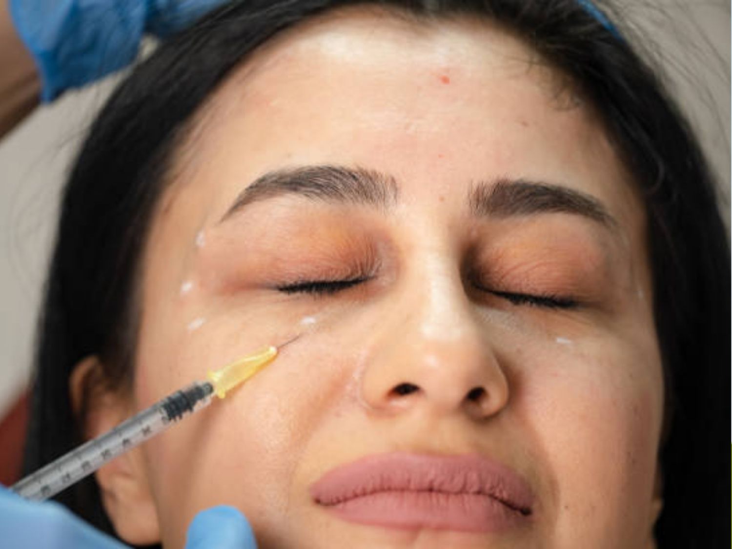 Tiêm thâm quầng mắt cải thiện tình trạng thâm sạm, lõm và thiếu sức sống
