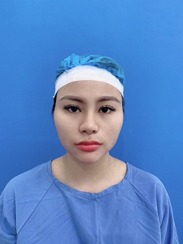 Gò má cao do xương cần phẫu thuật chứ không tiêm được