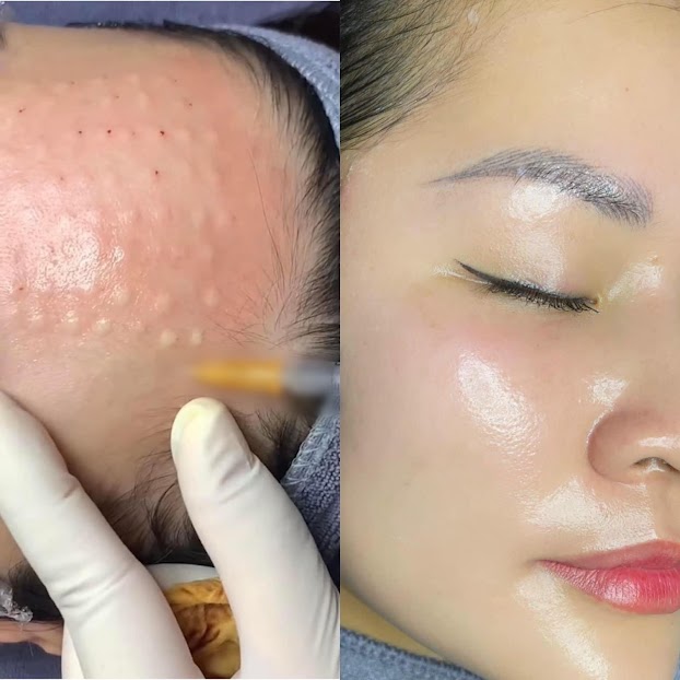 Tiêm Meso Exosome giúp da căng bóng, cải thiện độ đàn hồi hiệu quả