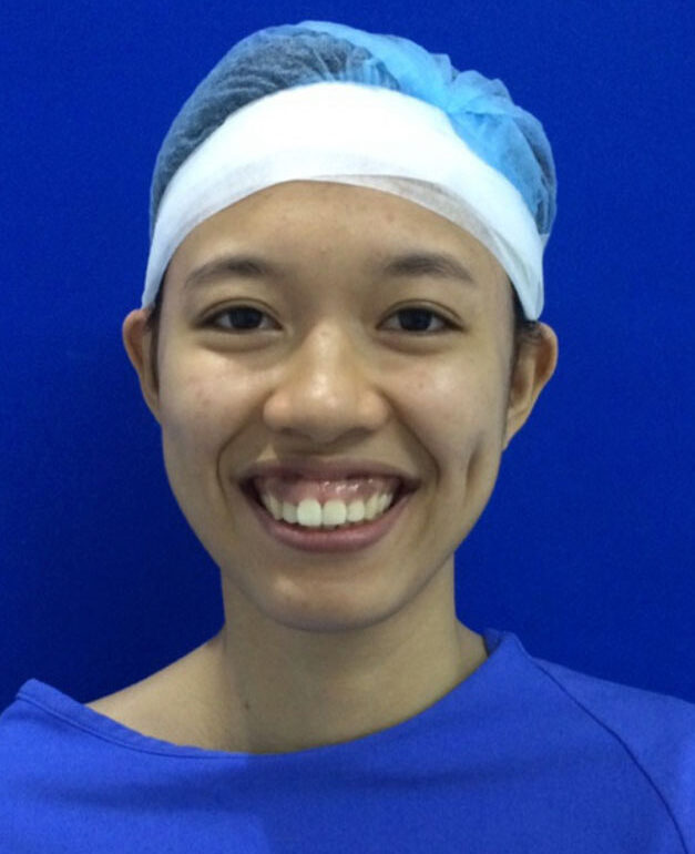 Tình trạng hô do hàm quá phát