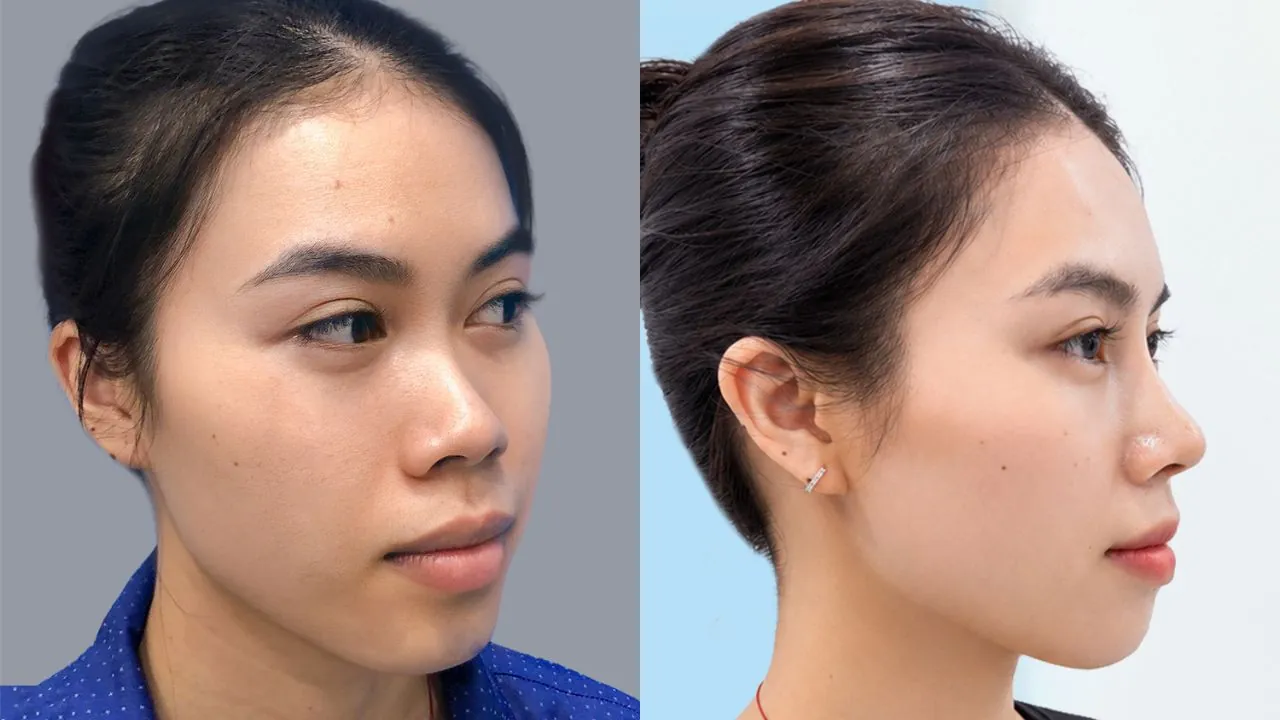 Đỗ Thị Ái Vy mũi gãy tẹt, sau nâng mũi tại Kangnam hồi phục ổn định. Dáng mũi sau 1 tháng vào form cơ bản