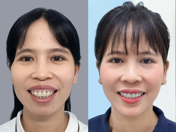 Khách hàng trước và sau khi chỉnh hàm hô, tự tin hơn với nụ cười đẹp