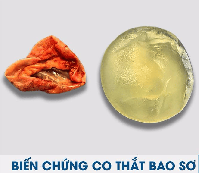 Co thắt bao xơ