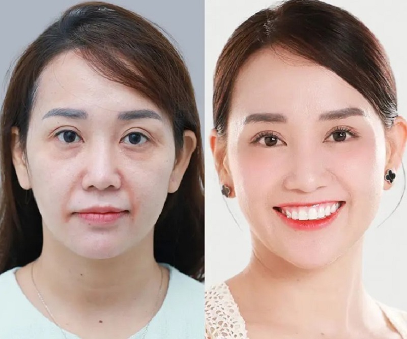 Khuôn mặt chị khách căng bóng, tươi trẻ sau căng chỉ collagen
