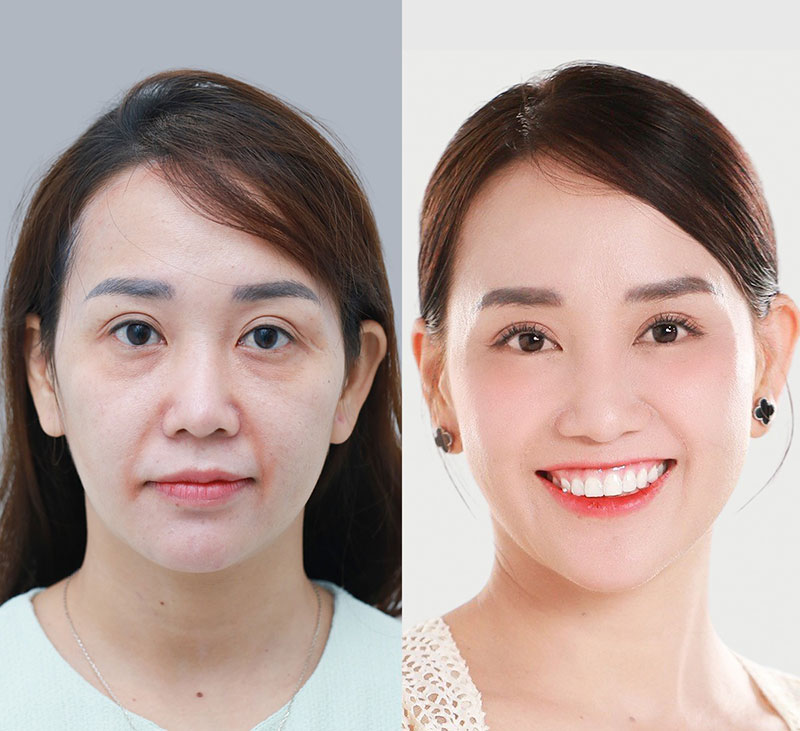 Căng chỉ da mặt giúp làn da kích thích sản sinh collagen