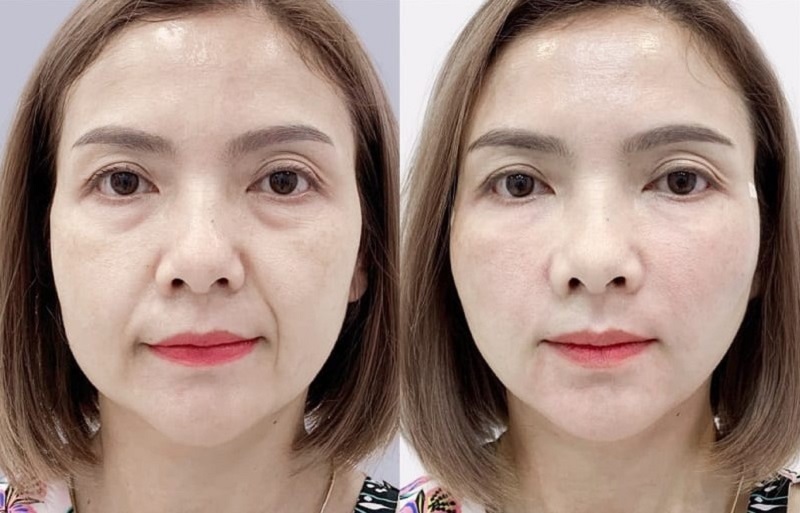 Vùng da được cấy chỉ kích thích sản sinh collegen tươi trẻ hơn