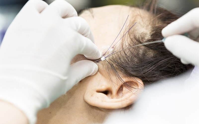 Cấy chỉ nâng đỡ được vùng da chảy xệ