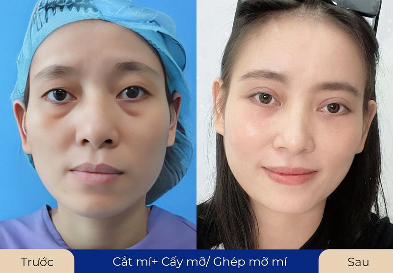 Cấy mỡ mí dưới giúp làm đầy vùng mắt trũng sâu, hốc hác