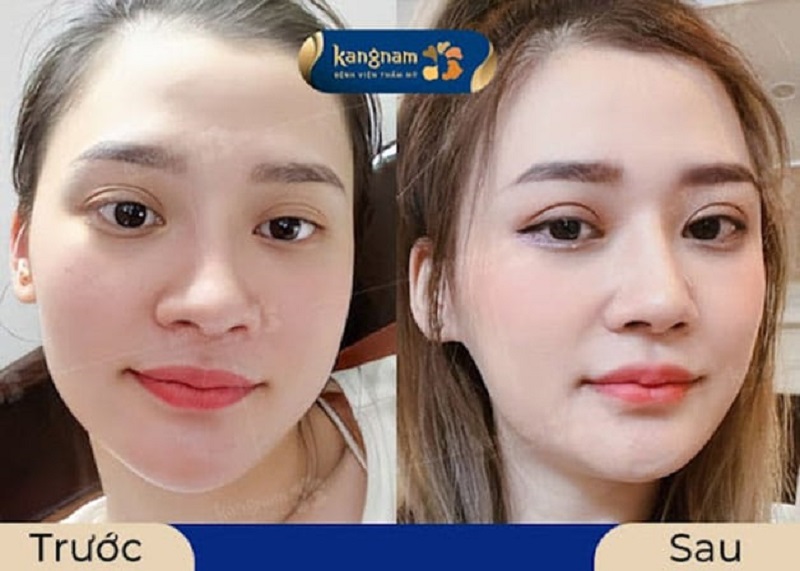 Cấy mỡ mí mắt giúp khuôn mặt trẻ trung, khắc phục được khuyết điểm