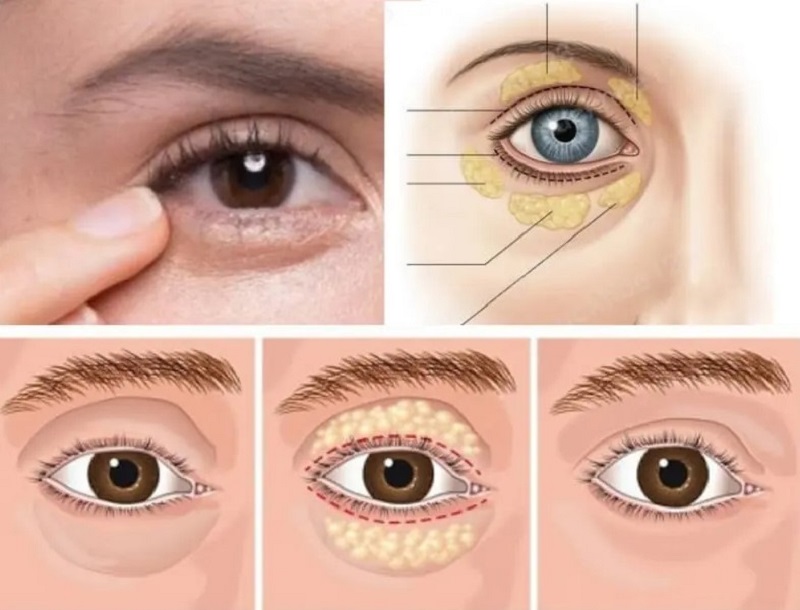 Mỡ tự thân được lấy từ cơ thể khách hàng sau đó được chiết tách và tiêm vào vùng mí mắt