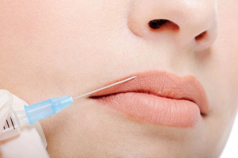 Cấy mỡ môi giúp tạo đôi môi căng mọng, quyến rũ