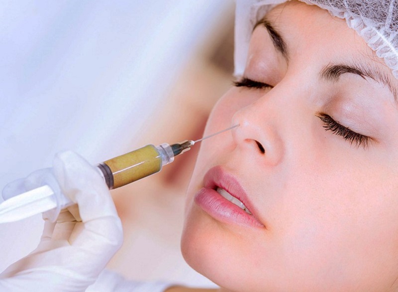 Cấy mỡ mũi có tác dụng trong vài năm