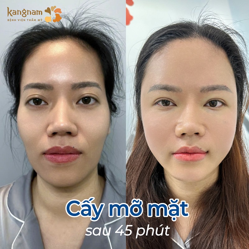 Thời gian cấy mỡ diễn ra nhanh