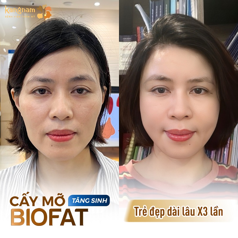 Cấy mỡi Bio Fat tăng sinh duy trì vẻ trẻ đẹp lâu dài