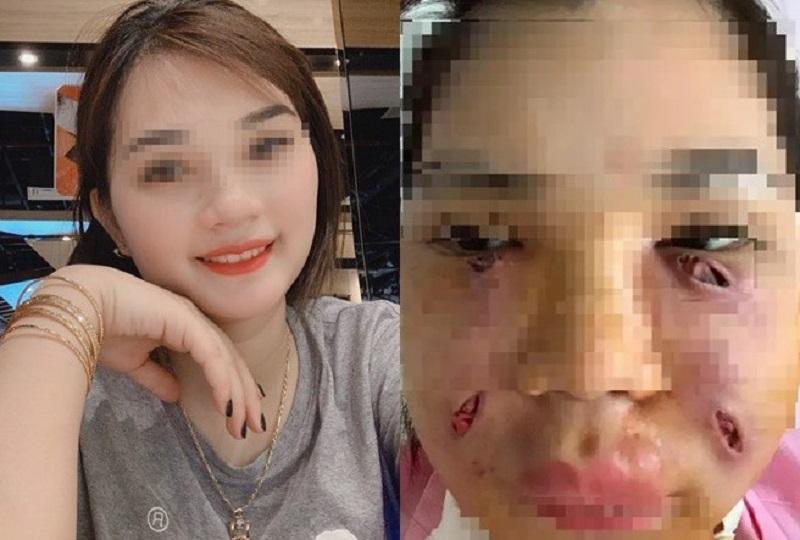 Cấy mỡ tự thân bị hỏng có thể do mỡ bị hoại tử