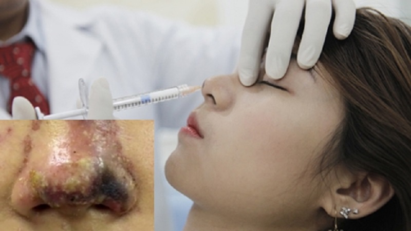 Vùng cấy mỡ bị biến dạng, mất cân đối