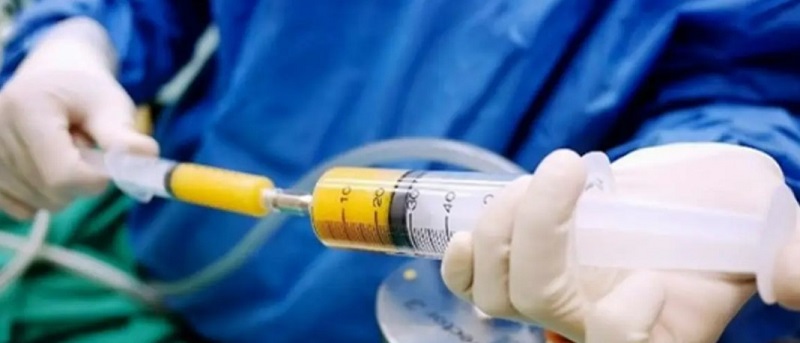Cấy mỡ tự thân vào cằm giúp khắc phục tình trạng cằm ngắn, lẹm