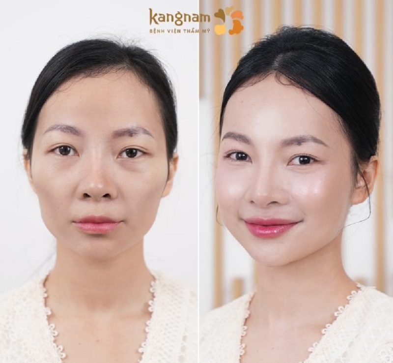 Khuôn mặt vline, cân đối hơn sau cấy mỡ cằm