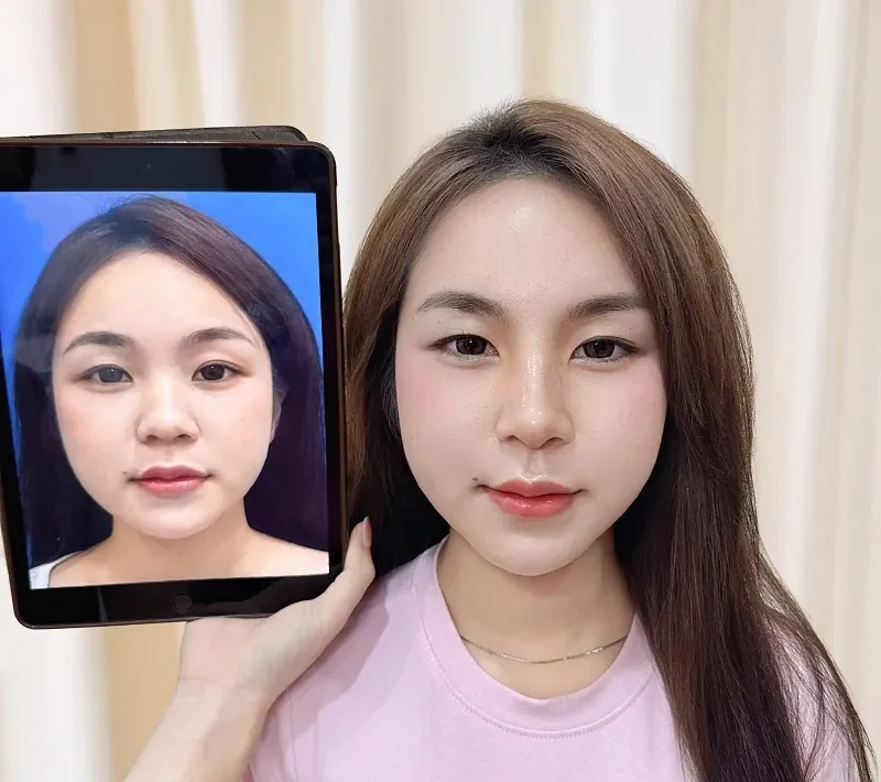 Gia Ân sở hữu gương mặt thanh tú nhưng gặp tình trạng sống mũi thấp, đầu mũi to và cánh mũi bè, sau khi chỉnh sửa sở hữu dáng mũi cao thon thanh thoát