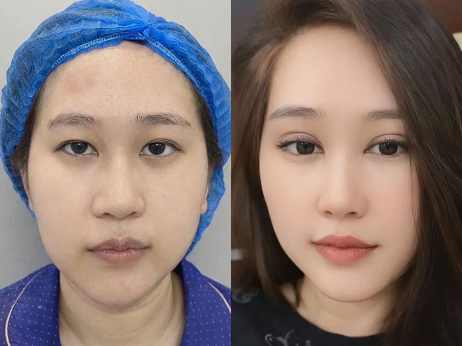 Hương Quỳnh trước và sau khi sửa mí, mắt cân đối và gương mặt sắc nét hơn