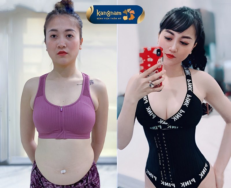 Đeo đai định hình giúp vùng bụng nhanh vào form, giảm sưng tấy