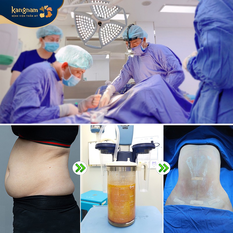 Tuân thủ hướng dẫn sau khi hút mỡ bụng của bác sĩ