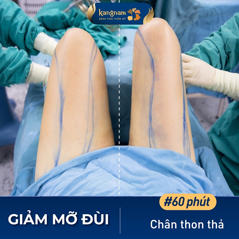 Vùng đùi được thon gọn sau khi hút mỡ