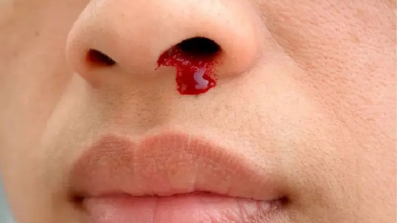 DẤU HIỆU TỤ DỊCH SAU NÂNG MŨI THƯỜNG THẤY LÀ SƯNG NỀ VÀ CĂNG BÓNG VÙNG ĐẦU MŨI