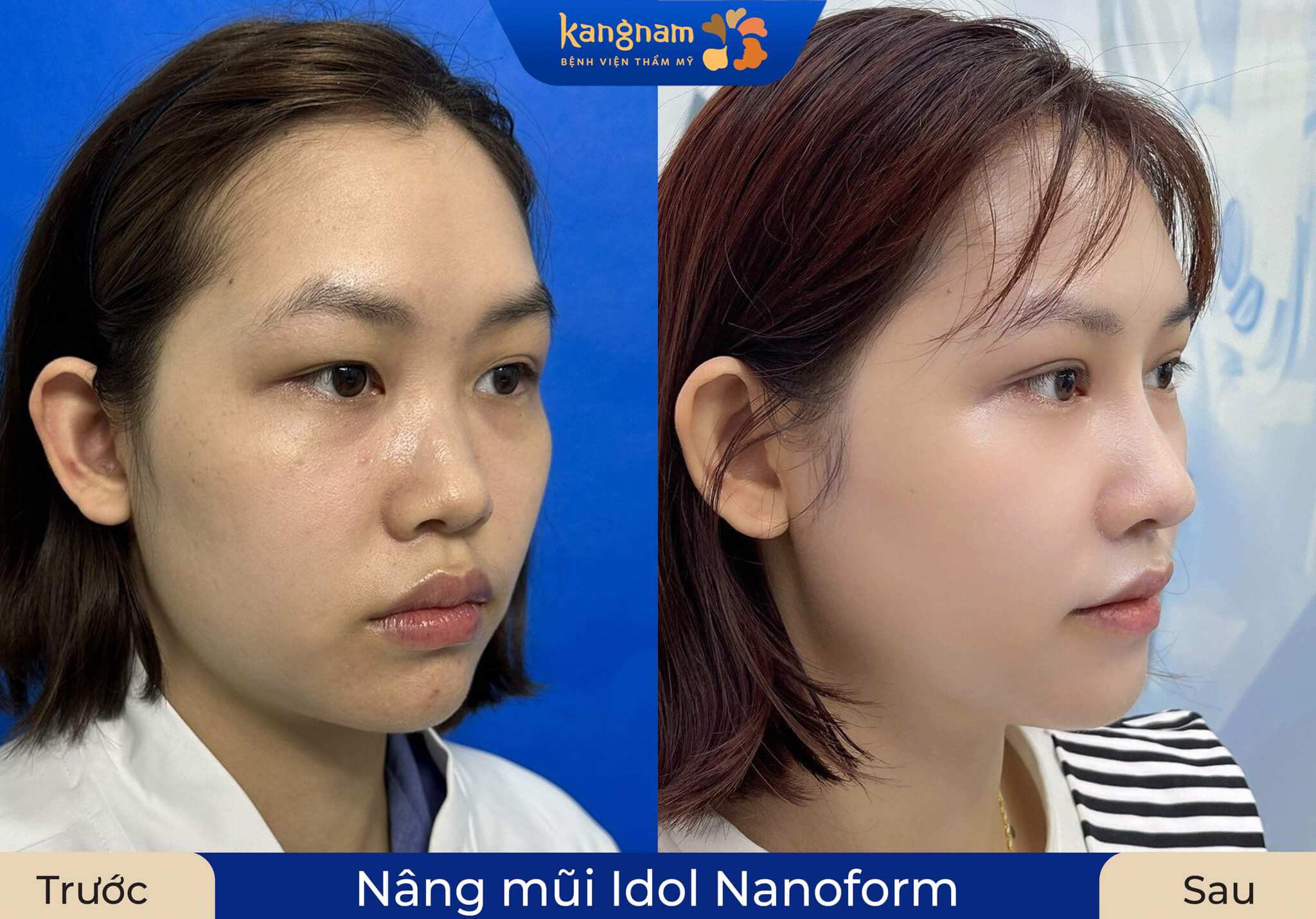 Nâng mũi cấu trúc khắc phục toàn diện khuyết điểm cho người có da mũi mỏng