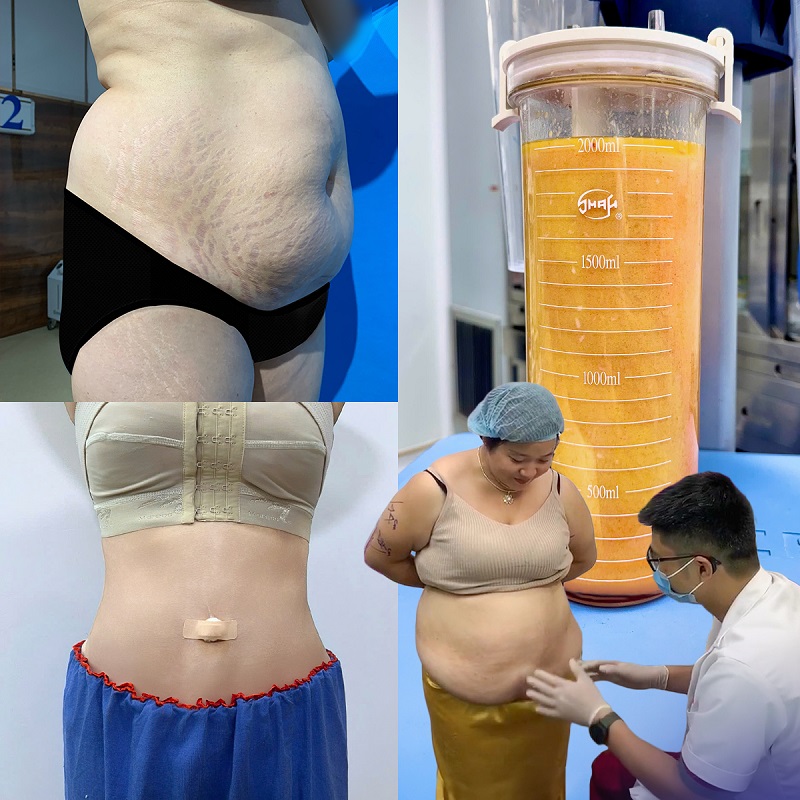 Hút mỡ bụng giúp loại bỏ mỡ thừa nhanh, định hình vòng eo thon gọn