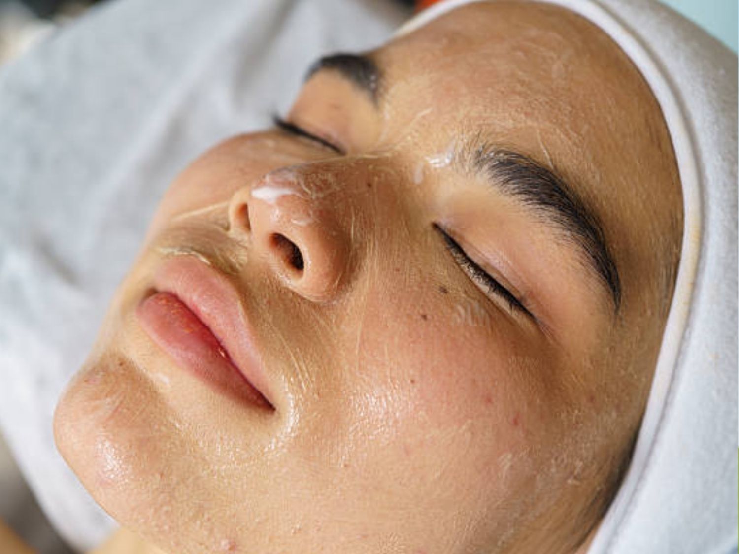 Peel trị thâm thì thời gian cụ thể phụ thuộc vào độ sâu của thâm
