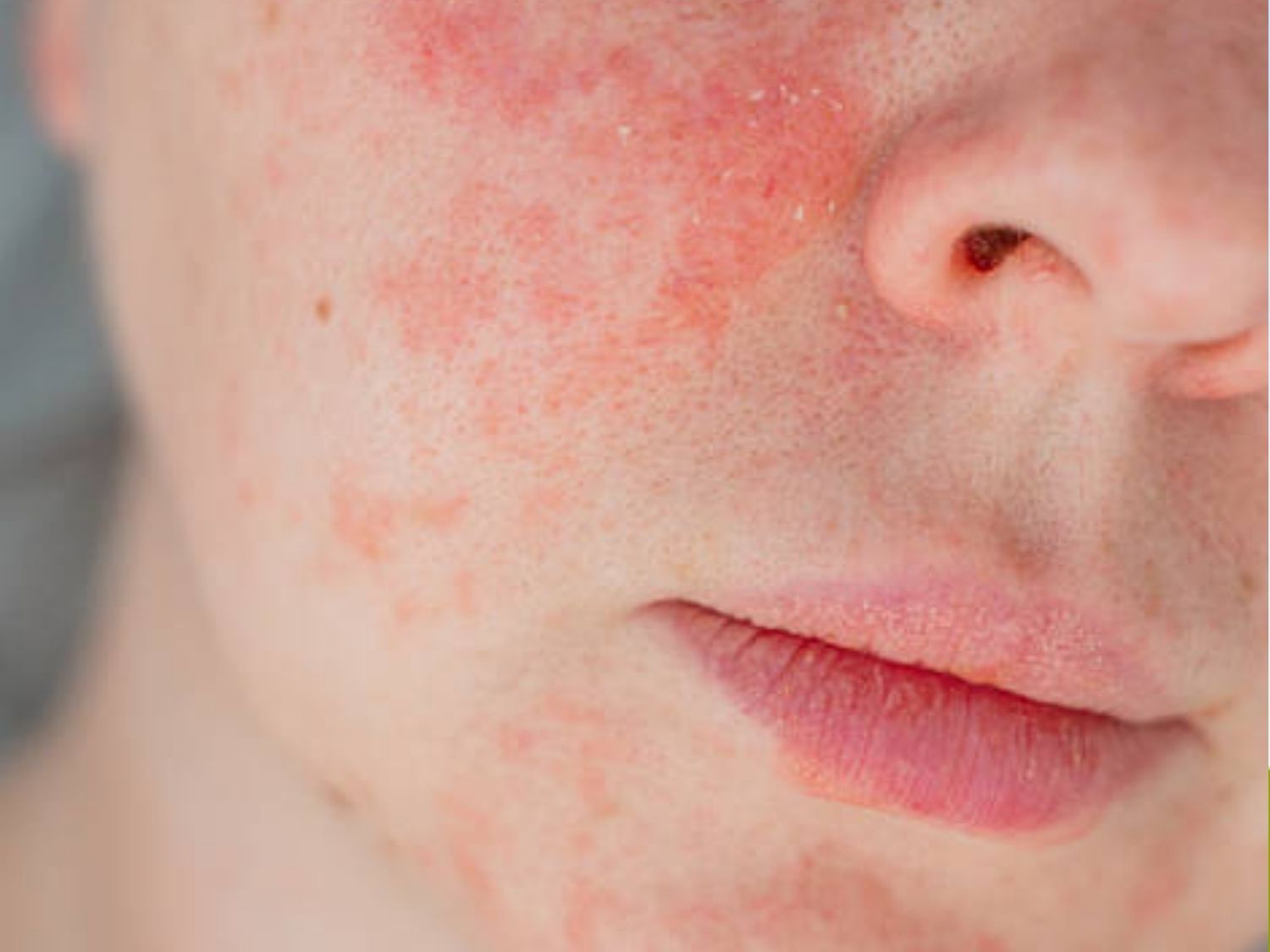 da mặt kích ứng do không hợp với hoạt chất peel da