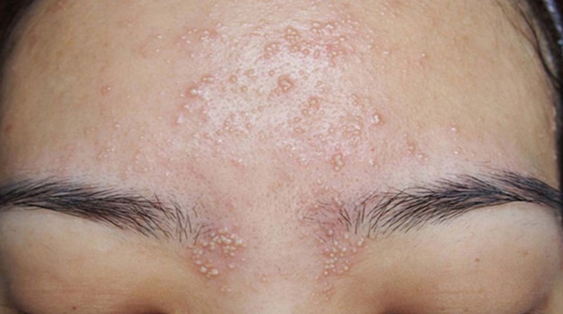 Da nổi mụn chi chít sau khi peel