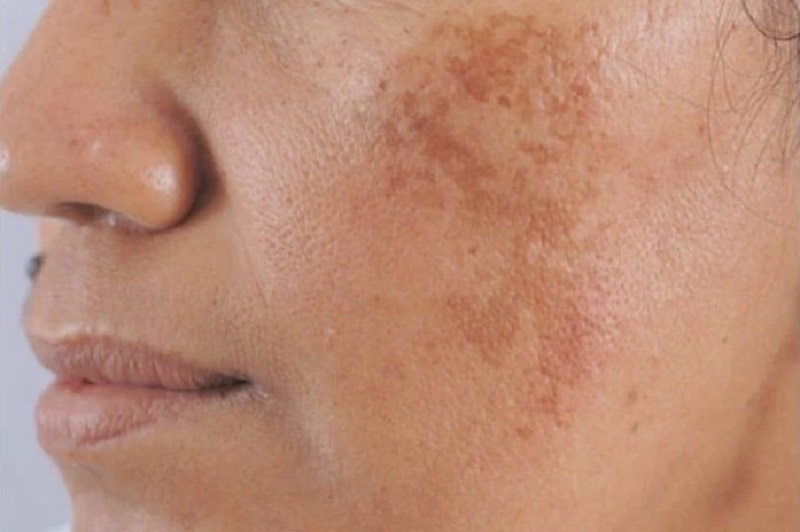 Da bị tăng sắc tố khi không được bảo vệ đúng cách